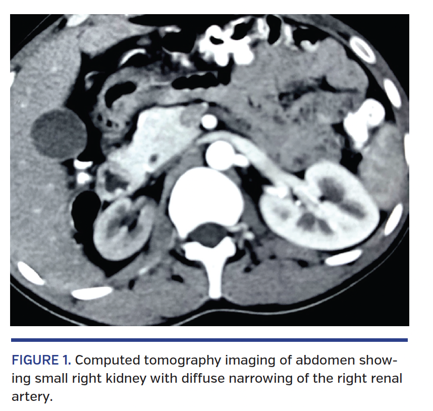 Percutaneous Renal Artery Stenting With Optical Coherence Tomography